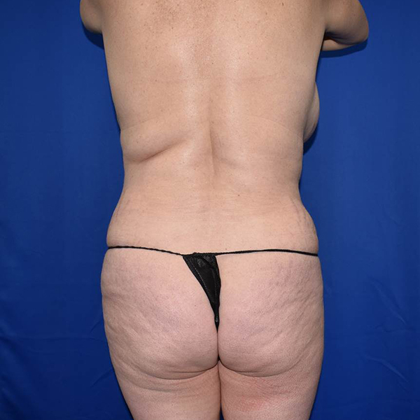 Patient 19, view 1 view before liposuction