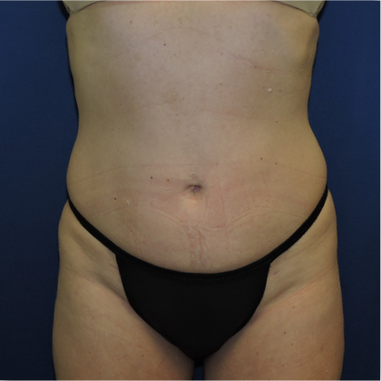 Patient 16, view 1 view after liposuction