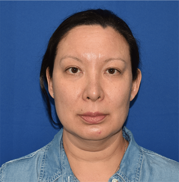 Patient 14, view 1 view before chin liposuction
