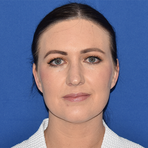 Patient 36, view 1 view after rhinoplasty