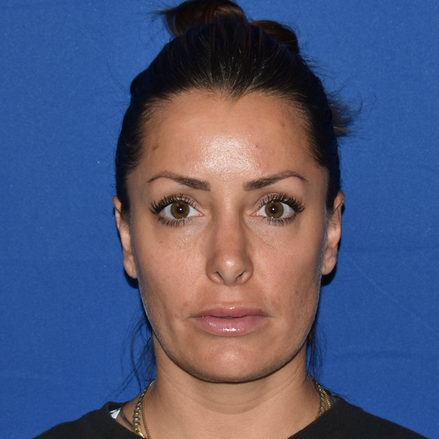 Patient 35, view 1 view after rhinoplasty