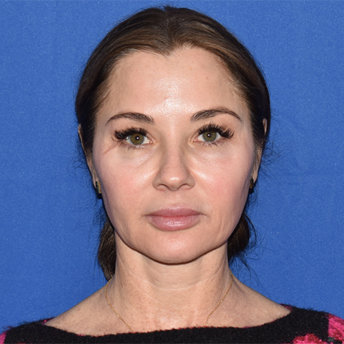 Patient 06, view 1 view before blepharoplasty