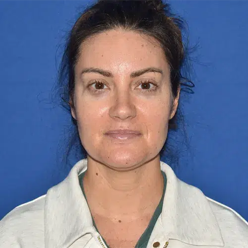Patient 12, front view before chin liposuction