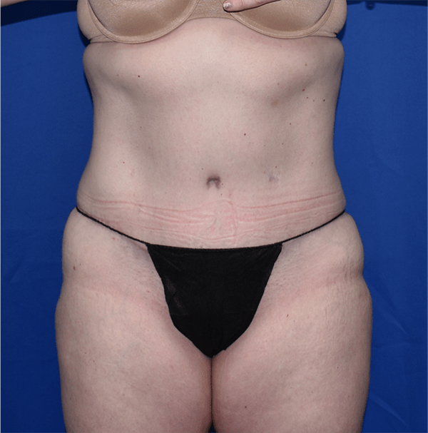 Patient 16, view 1 view after tummy tuck