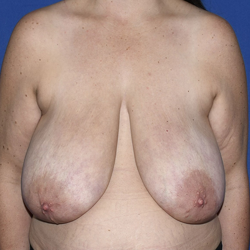 Patient 10, front view before breast reduction