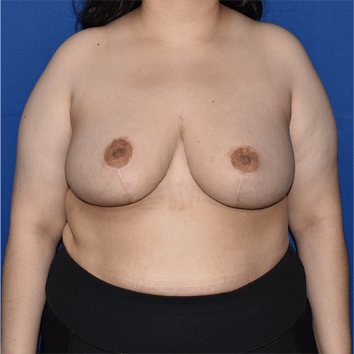Patient 20, view 1 view after breast reduction
