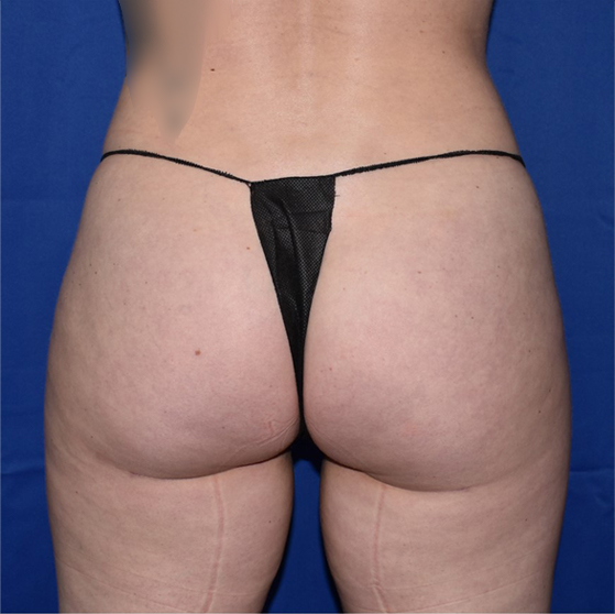 Patient 16, view 1 view after brazilian butt lift