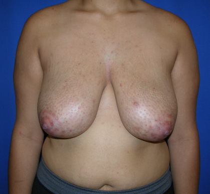 Patient 13, view 1 view before breast reduction