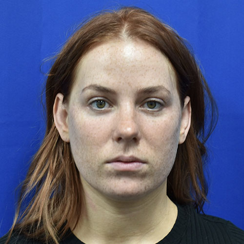 Patient 09, front (1) view after blepharoplasty