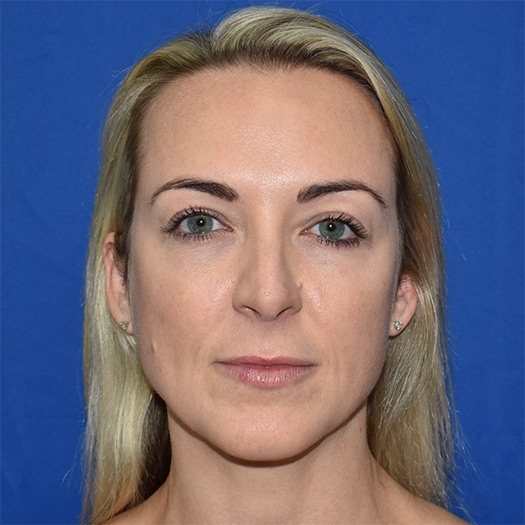 Patient 01, view 1 view after blepharoplasty