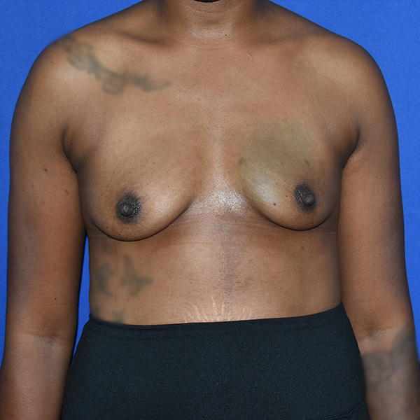 Patient 74, view 1 view before breast augmentation